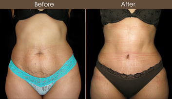 NYC Abdominoplasty Surgery Before & After